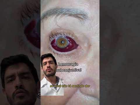 Vídeo: Devo usar lentes de contato com hemorragia subconjuntival?