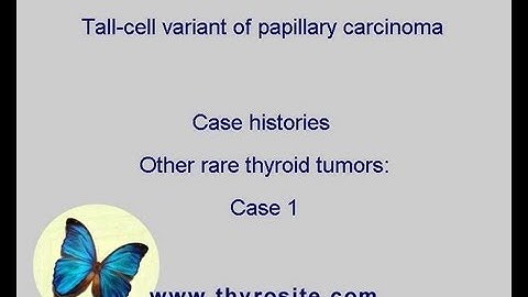 Tall cell variant of papillary carcinoma. Other rare tumors - case 1