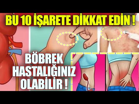 Bu 10 Belirti Sizde Varsa Böbreklerinizde Sorun Var Demektir. EN İYİ GELEN BESİNLER !