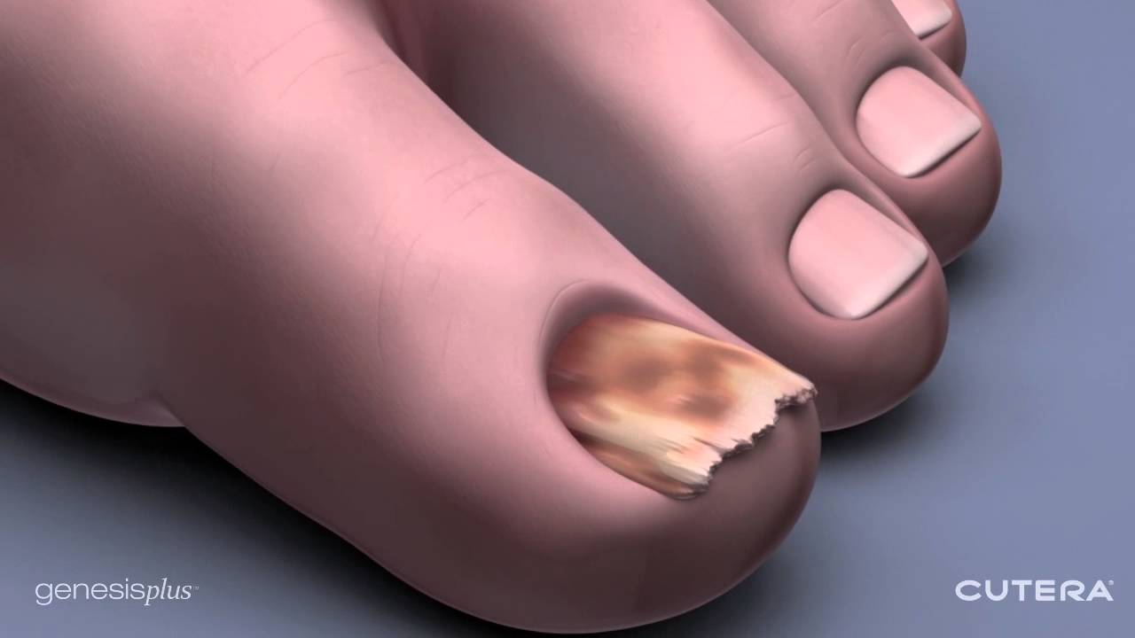 IPL Fungal Nail Infection – Elite Aesthetic Clinic