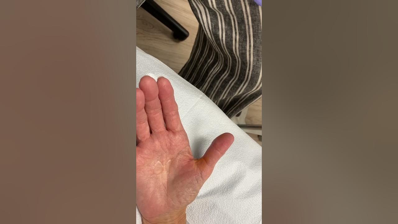 Trigger Thumb Injection YouTube Trigger thumb injection youtube