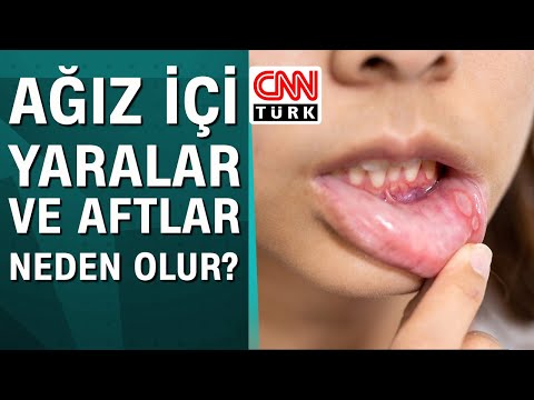 Ağız içi yaralar ve aftlar neden olur?