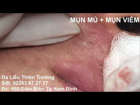 MỤN MỦ MỤN VIÊM ĐẦY MẶT BẠN NAM