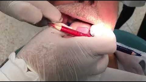 Visit 2: Extension of the special tray in the retromoar pad area