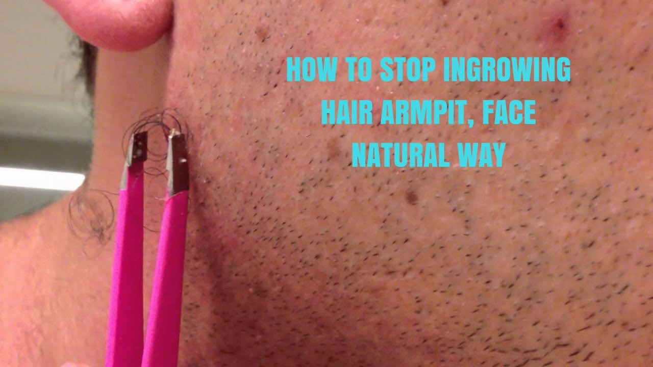 How To Stop Ingrowing Hair Armpit Face Natural Way Youtube