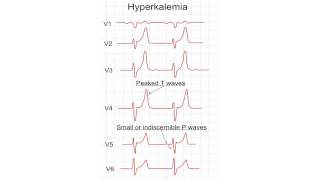 Possible ECG changes in Hyperkalemia