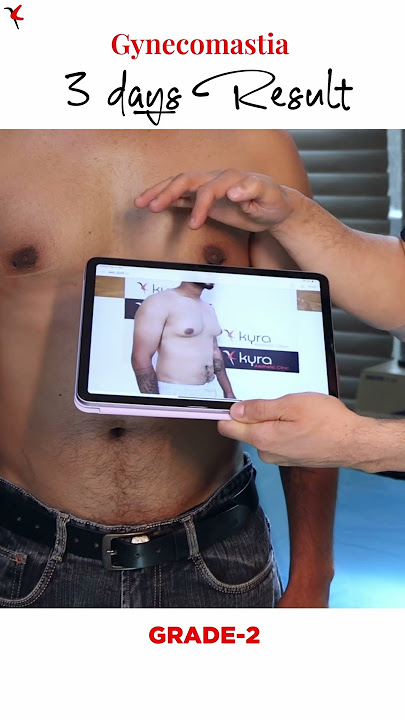 3 Days After Gynecomastia Surgery | Real Result Shown