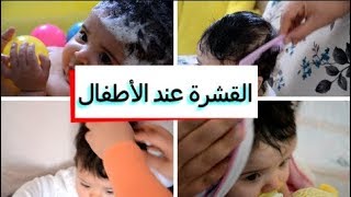 علاج القشرة عند الاطفال الرضع