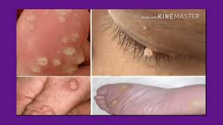 أسرع علاج منزلى التخلص من الزوائد الجلدية اللحمية بدون ألم skin tags removal