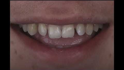 Making class IV restorations predictable