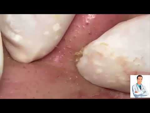 Severe Cystic Acne On the Nose and FAce - Blackheads Extraction Acne Treatment Session 