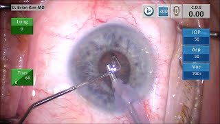 TBWTDCS #55: Tiny Pupil, Soft Lens, Using the Chopper as an Iris Retractor screenshot 2