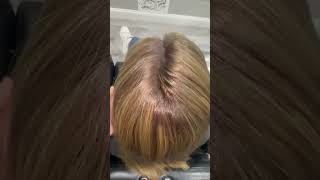 Before And After A CNC Hair And Scalp Prosthetic