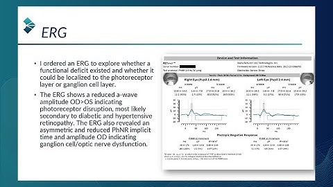 RETeval Case Study: ERG Provides Clarity When Fields, OCT are Inconclusive (Mike Cymbor, OD, FAAO)