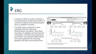RETeval Case Study: ERG Provides Clarity When Fields, OCT are Inconclusive (Mike Cymbor, OD, FAAO)