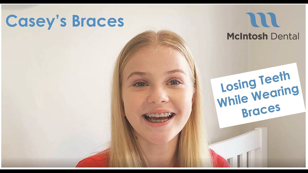 Caseys Braces Losing Teeth While Wearing Braces Youtube
