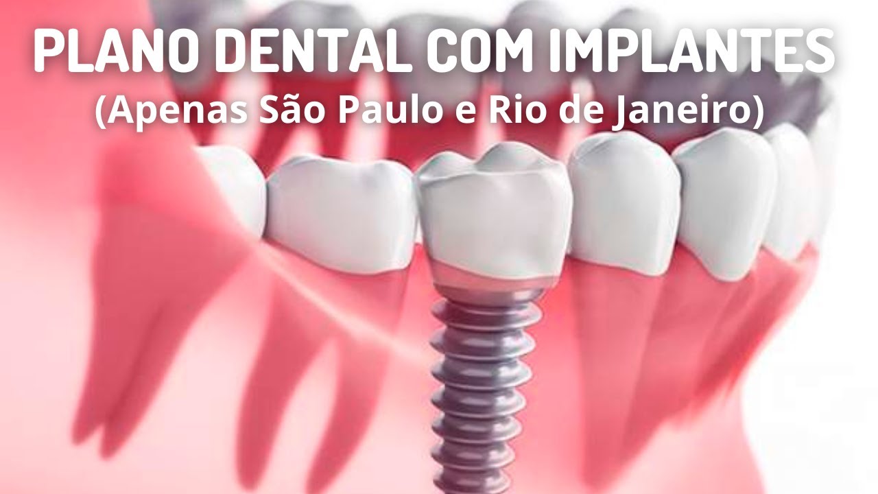 Plano Odontológico que cobre Implantes Dentários YouTube
