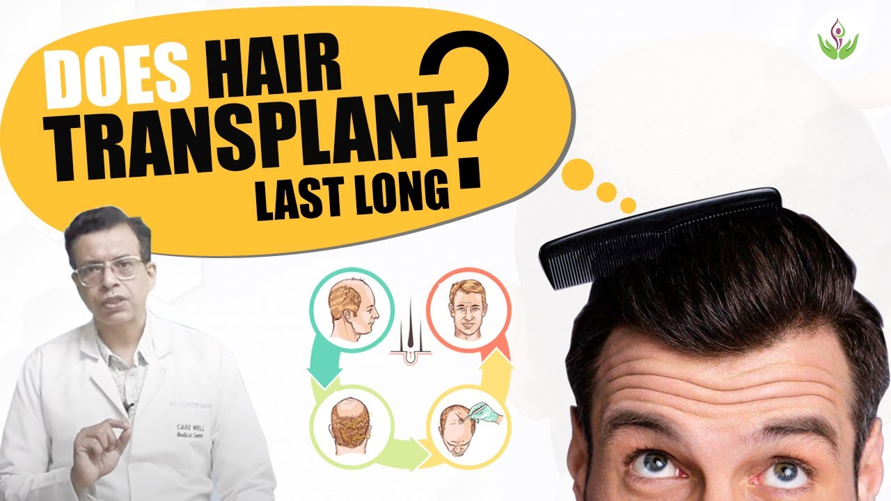 How Long Does Hair Transplant Last? Care Well Medical Centre YouTube