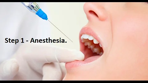 Dental Implant Procedure - Step by Step Guide