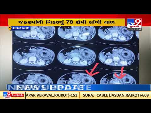 Ahmedabad : 78 cm hair strand removed from a 13 -yrs old girl's stomach |Gujarat |TV9GujaratiNews