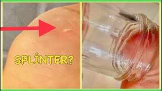 Don't squeeze out a splinter, as this may cause it to break into
smaller pieces that are harder remove. here's how remove them quickly
and safety in on...