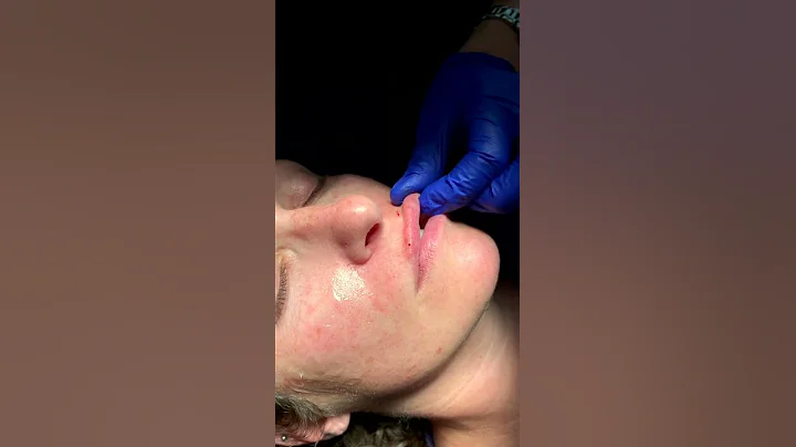 Lip Filler Demonstration | Dr. Elizabeth F. Callah...