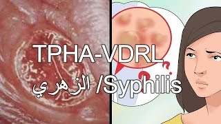 تحاليل الكشف عن الزهري - السفلس TPHA-VDRL Syphilis !!!