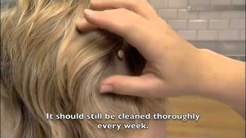 Baha - Keeping the Abutment Clean