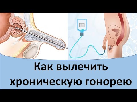 Как вылечить хроническую гонорею