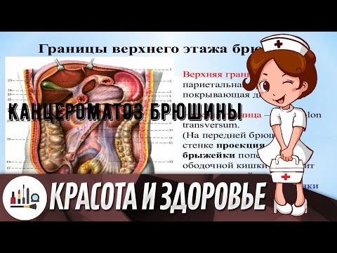 Канцероматоз брюшины