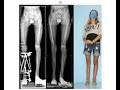 Systematic Utilitarian Procedure for Extremity Reconstruction SUPER