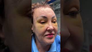 FRONTOTEMPORAL LIFTING | ЛОБНО-ВИСОЧНЫЙ ЛИФТИНГ #лисьиглазки #ponytaillifting #блефаропластика #top