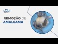 Remoo de amalgama com sistema cvdentus