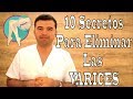 10 Formas de ELIMINAR las VARICES Para Siempre de Manera Natural