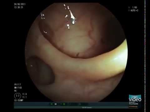 Colonic Diverticulosis