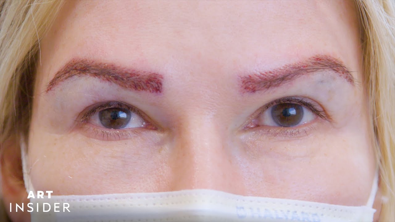 Eyebrow Transplants Restore Brows With Real Hair - YouTube