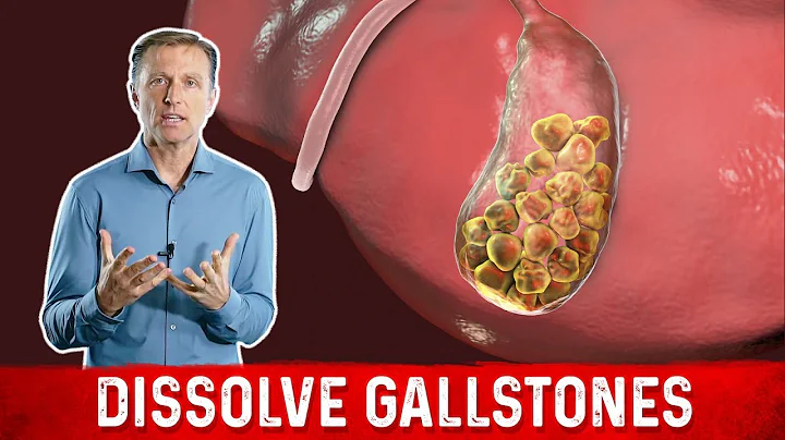 What Causes Gallstones & How to Treat Them  Dr.Berg