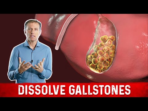 How to Dissolve Gallstones