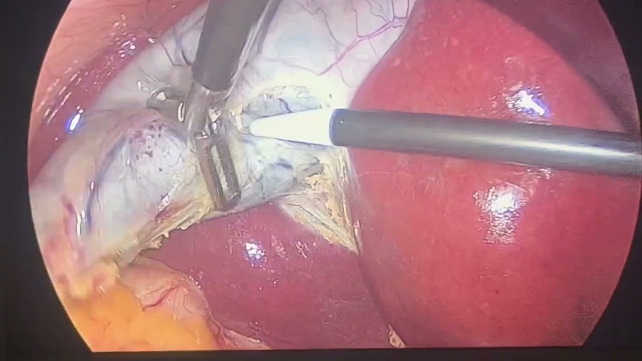 Hook dissection in laparoscopic cholecystectomy @drvikrantsinghchandail 