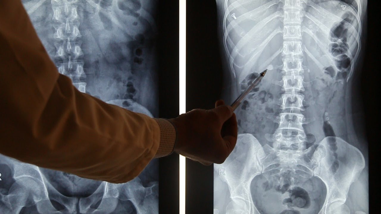 حصوات الكلى ...و طرق التشخيص بالاشعة التليفزيونية والسينية والمقطعية: إجابات لكل أسئلة المرضى