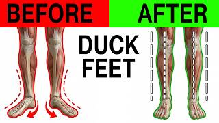 Why You Walk Like a Duck (And How to Fix It)