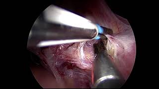 TLH for a case of previous 2 CS with technique of bladder dissection