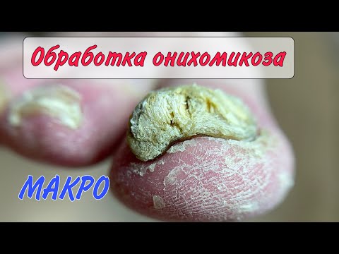 🍄ГРИБОК ногтей / ОНИХОМИКОЗ / медицинский педикюр