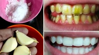 تبييض الأسنان في دقيقتين فقط - كيف تبيض الأسنان في المنزل؟  100٪ فعالة