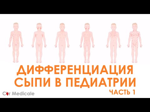 Сыпь в педиатрической практике: как правильно поставить диагноз при экзантемных заболеваниях?