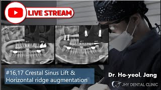 [Live surgery] #16,17 Crestal sinus augmentation with Pop-up drill &amp; Horizontal ridge augmentation