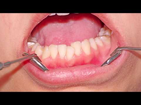 Video: Ortodontik əmzik Niyə Yaxşıdır