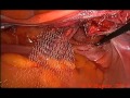 Laparoscopic hysterectomy &amp; colpopromontoriofixation