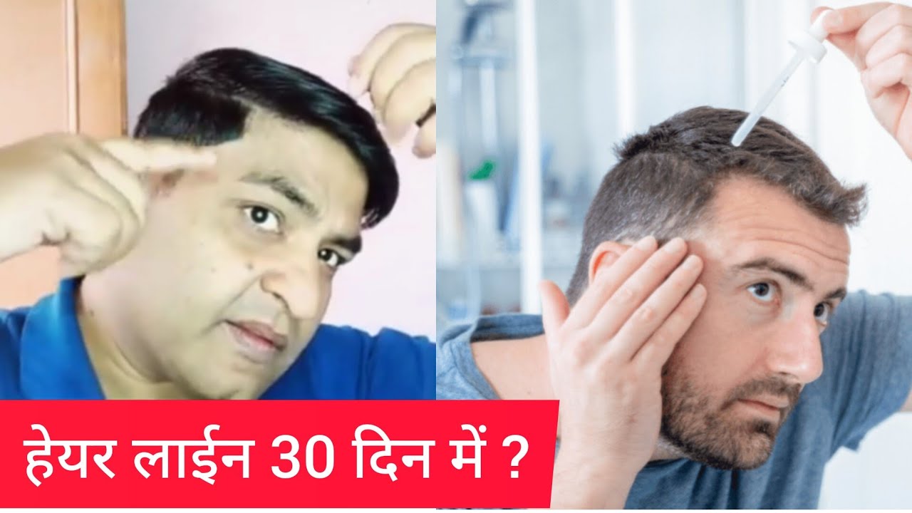 Receding Hairline Results How to apply Derma Roller on Hairline / Can