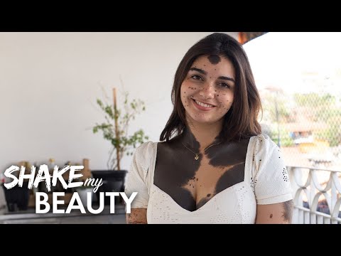 I'm 80% Covered In Birthmarks | SHAKE MY BEAUTY